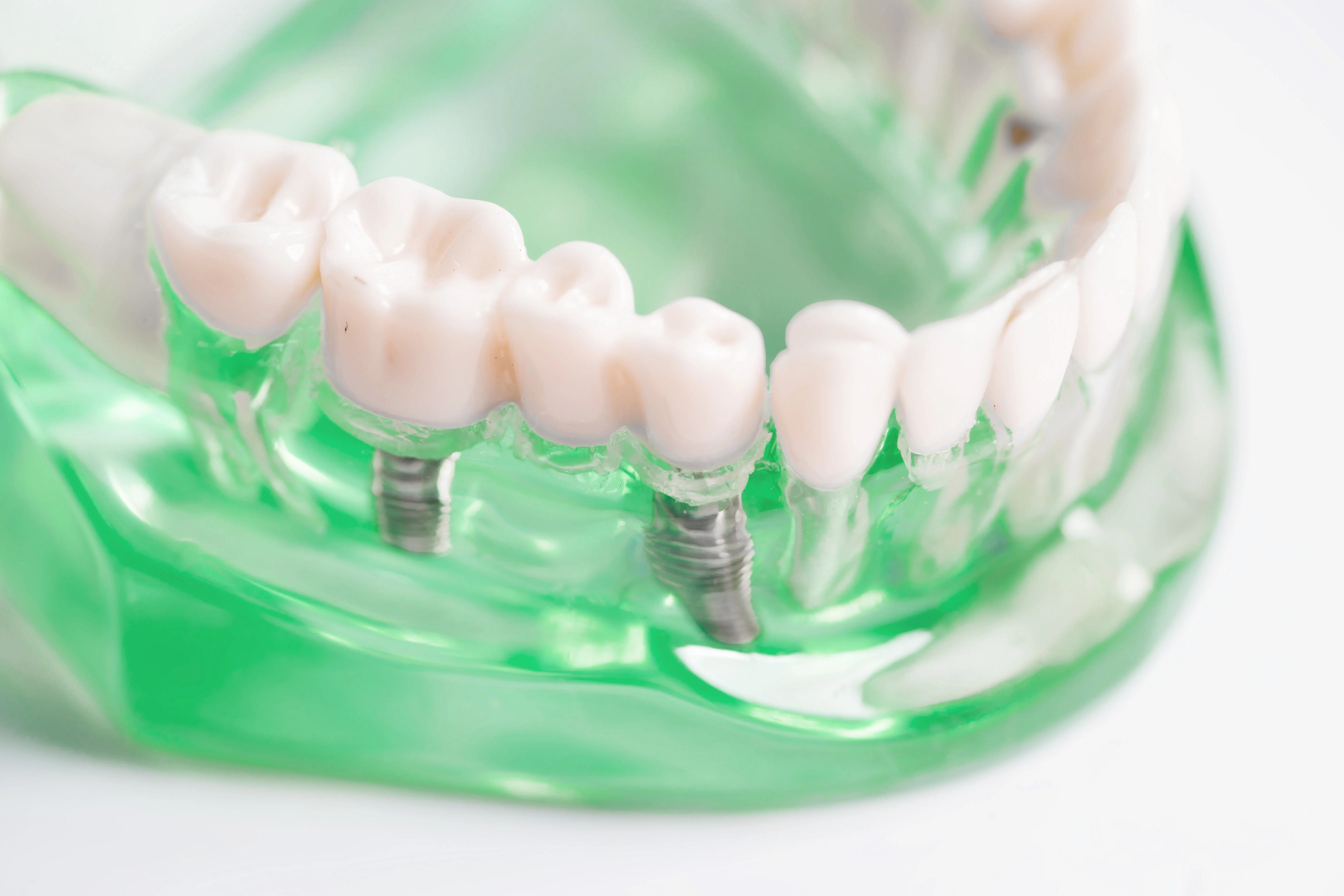 Dental Implant Artificial Tooth Roots Into Jaw Root Canal Dental Treatment Gum Disease Teeth Model Dentist Studying About Dentistry2