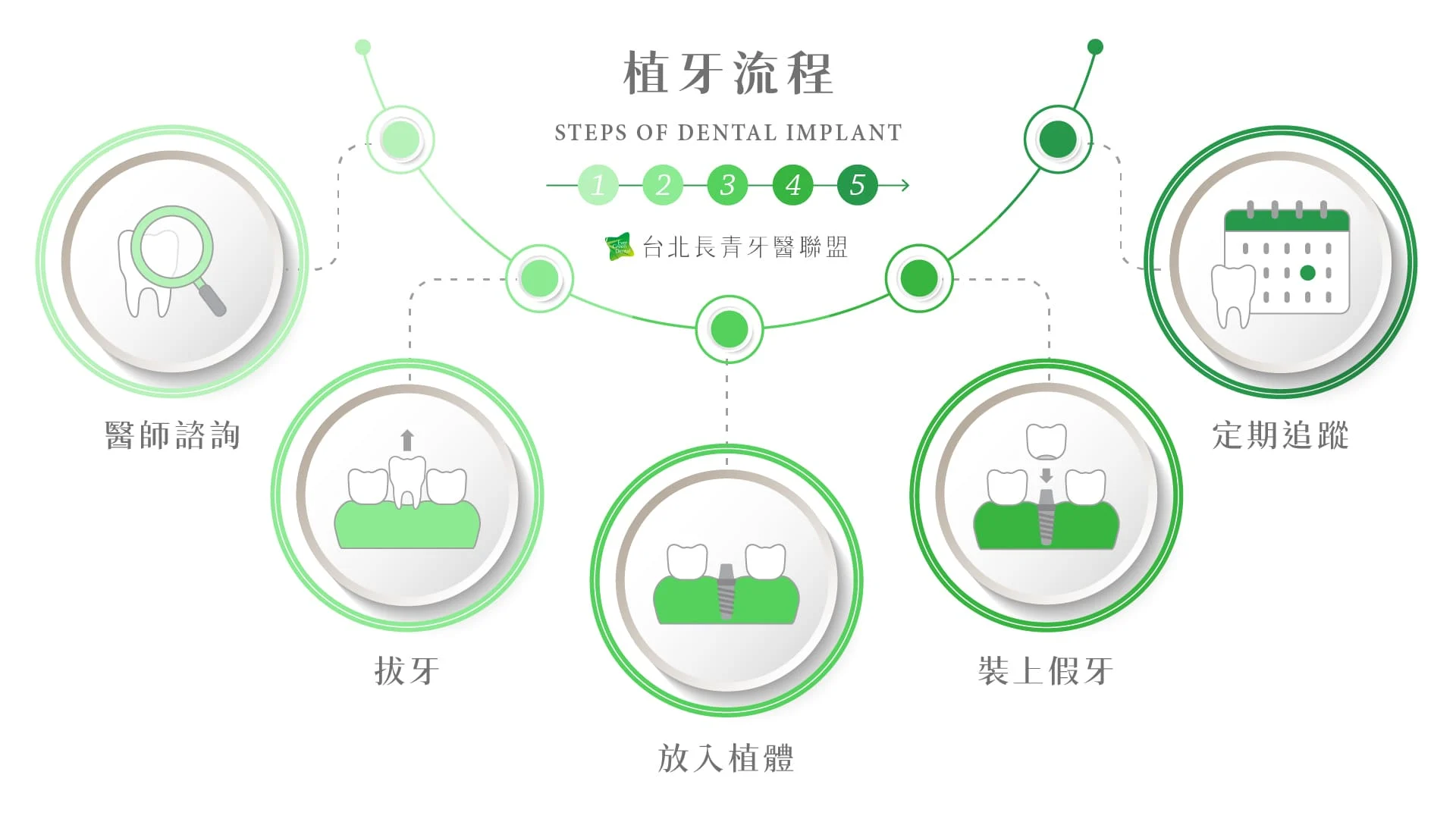 官網用圖 植牙流程